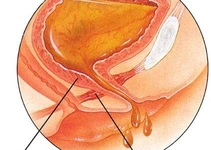 Akut Sistit Belirtileri ve Tedavisi Akut Sistit Belirtileri ve Tedavisi