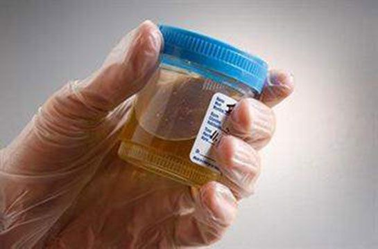 İnterstisyel Sistit Diyeti Nasıl Yapılır?