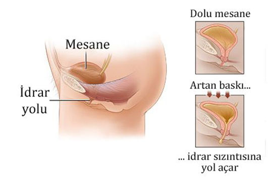 Sistit Hastalığı Belirtileri ve Tedavisi